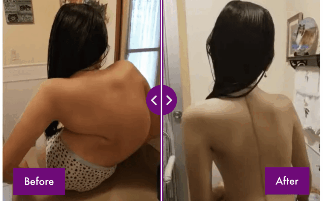 SMA, Muscular Dystrophy, and Osteogenesis Imperfecta – Spine Care, Orthopedic Interventions, and Long-Term Support