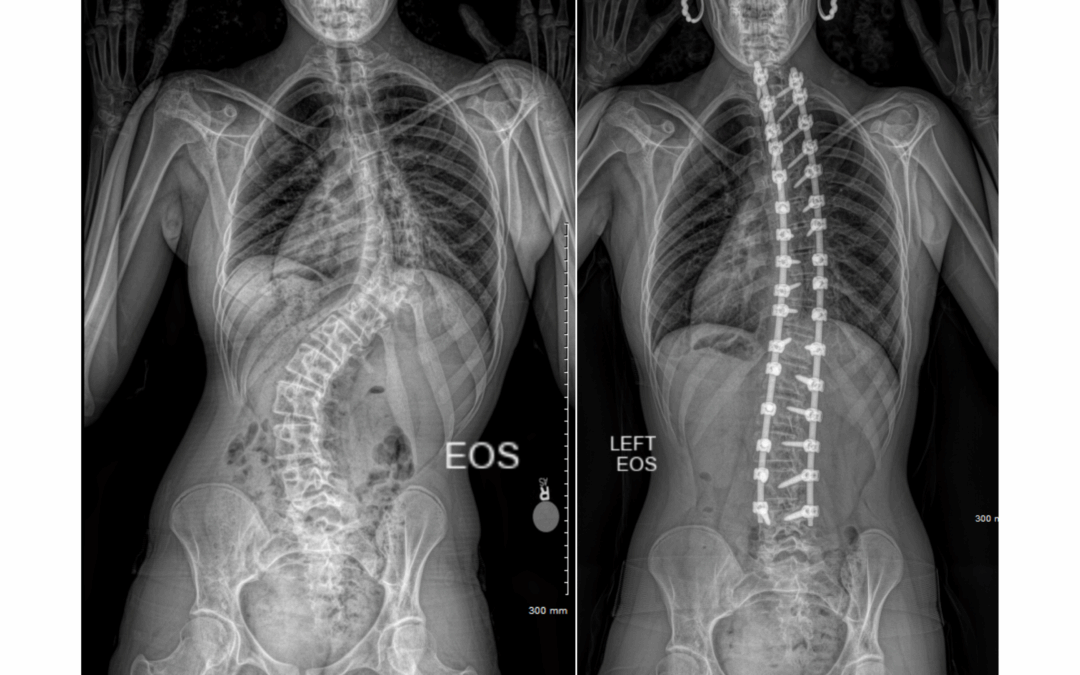 Prader-Willi Syndrome and Associated Spine Issues