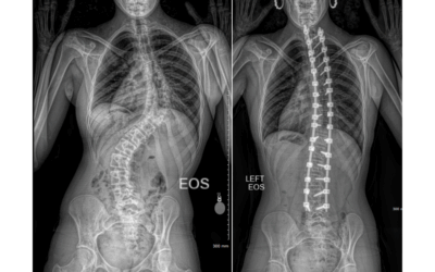 Prader-Willi Syndrome and Associated Spine Issues
