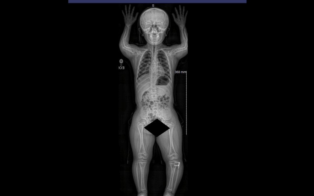Achondroplasia Spine Surgery in Children: Modern Approaches to Safe Growth and Long-Term Function