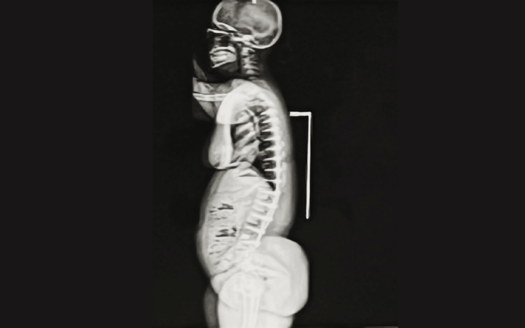 Achondroplasia Spine Surgery in Adults: Restoring Mobility and Quality of Life Through Advanced Care