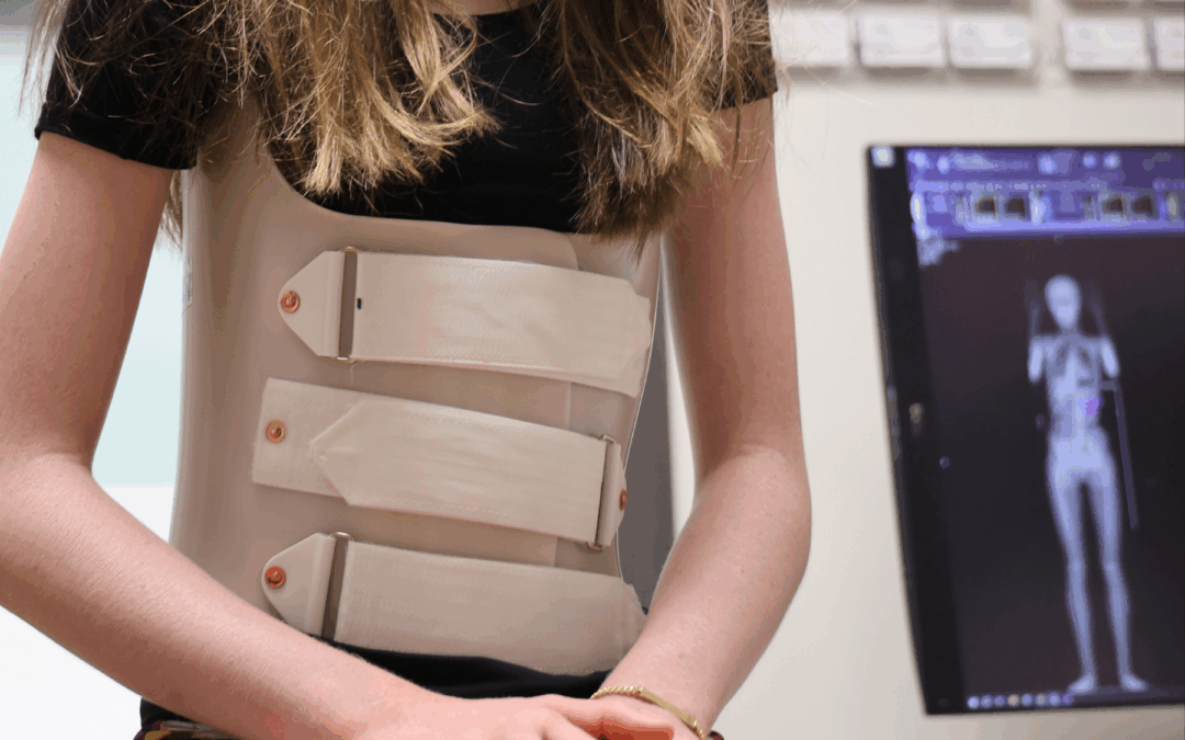 Understanding Prader–Willi Syndrome and the Spine