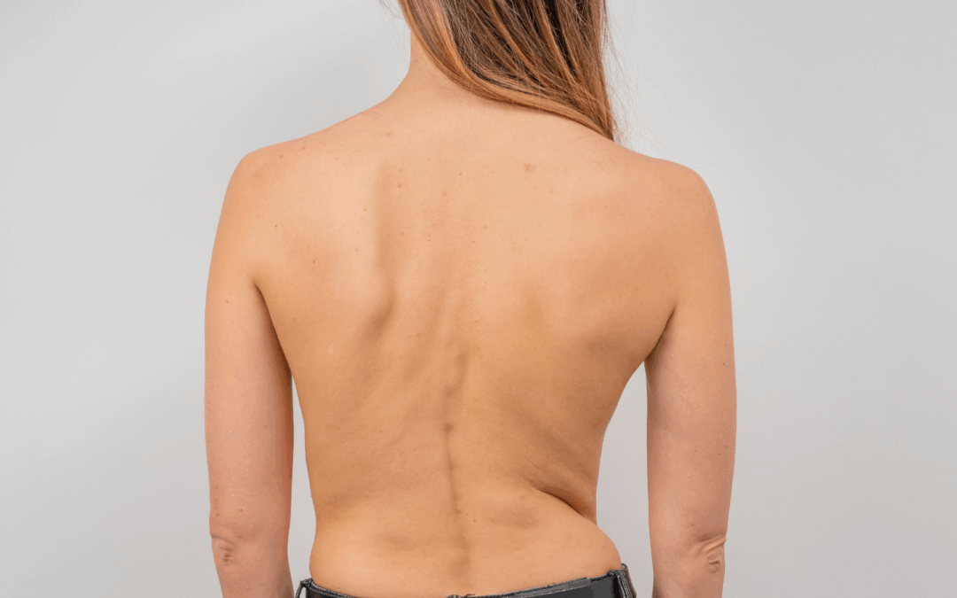 Arthrogryposis and the Spine: Modern Care for a Complex Condition