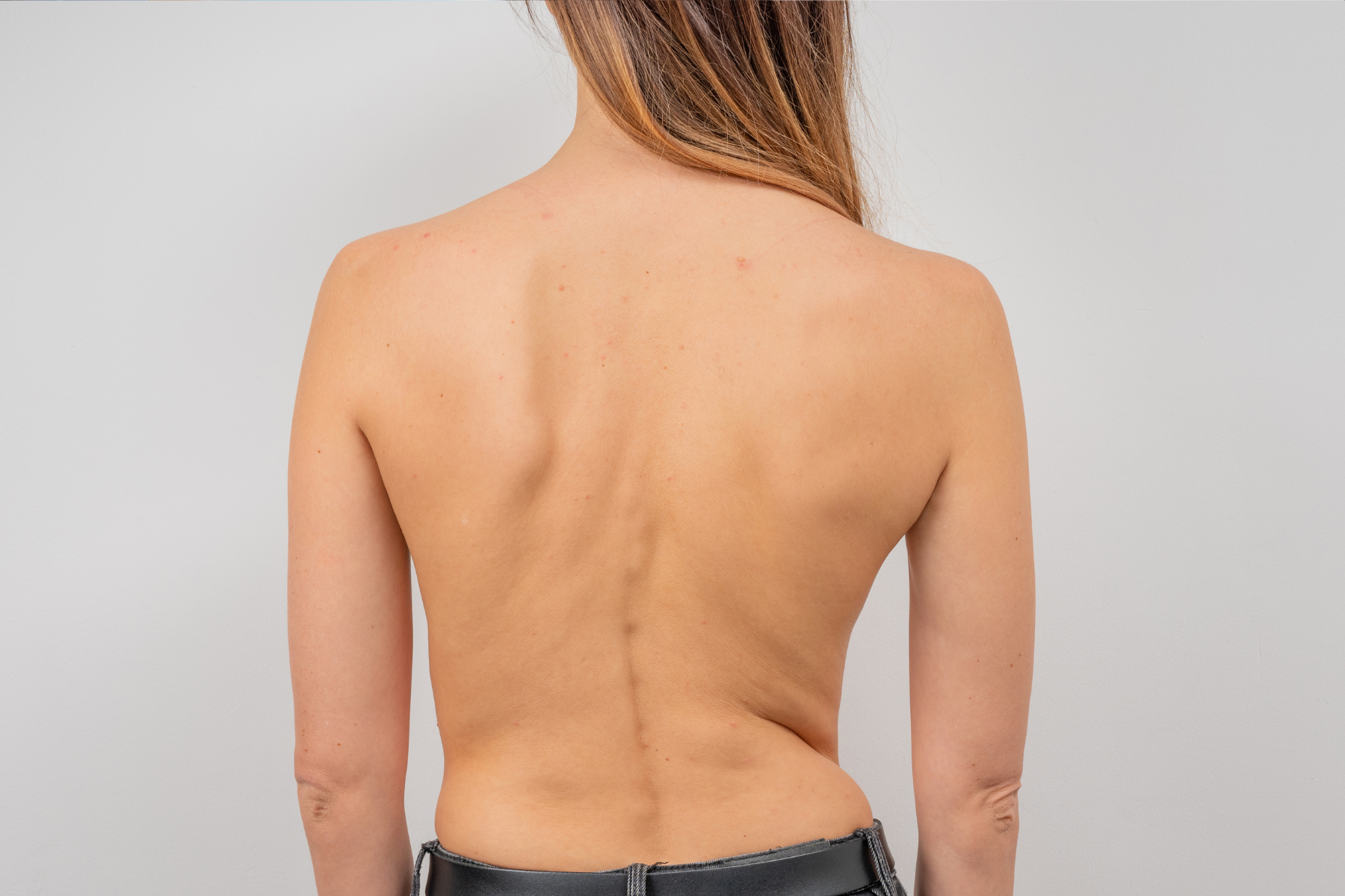 Back of a person with spinal curvature showing deformity.