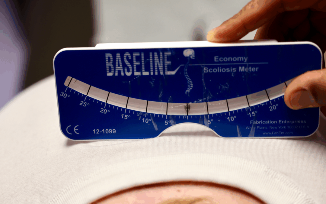 Neurofibromatosis Type 1 and the Spine: Treating Dystrophic Scoliosis with Modern Precision