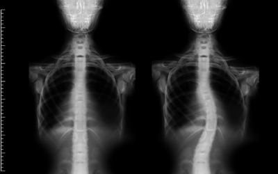 Understanding Scoliosis Types: Idiopathic, Congenital, & Neuromuscular